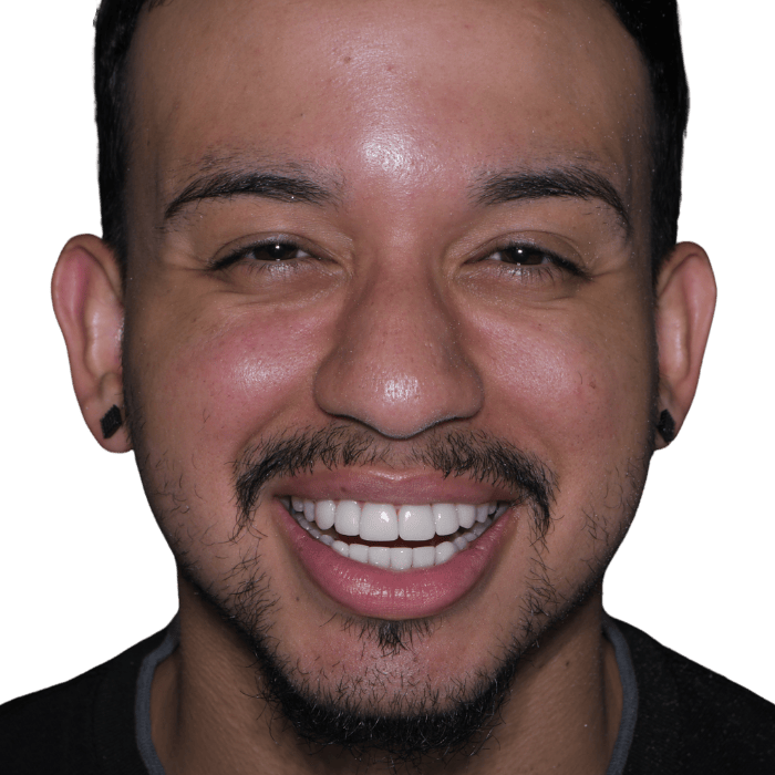 The patient is smiling after receiving a lumineers procedure in Mexico.