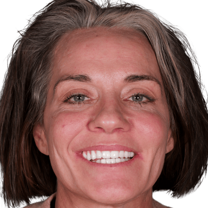 Traditional Dentures patient smiling after treatment in Mexico