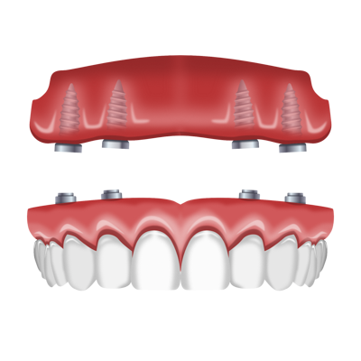 all on 4 dental implants